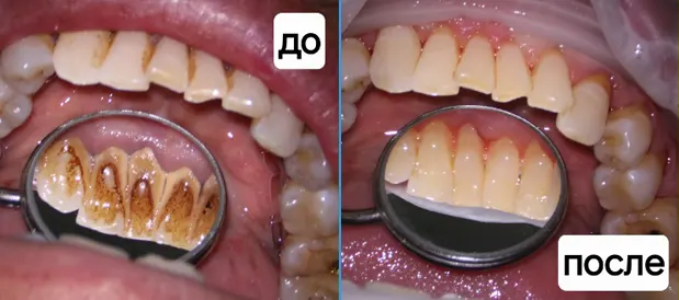 Чистка зубов, г. Кагул, Республика Молдова