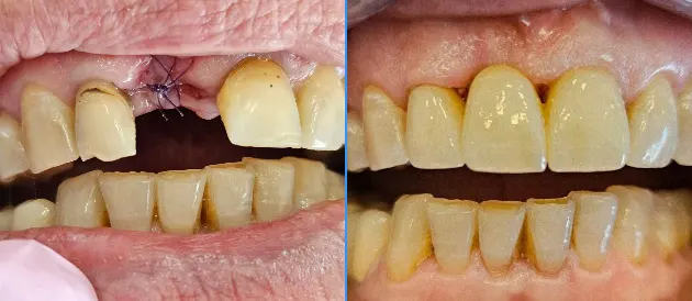 Протезирование на зубах | До/После